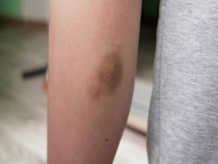 tips-for-bruises:-चोट-लगने-के-बाद-शरीर-पर-पड़े-नीले-निशान-तो-आजमाएं-ये-टिप्स,-जल्द-दिखेगा-असर